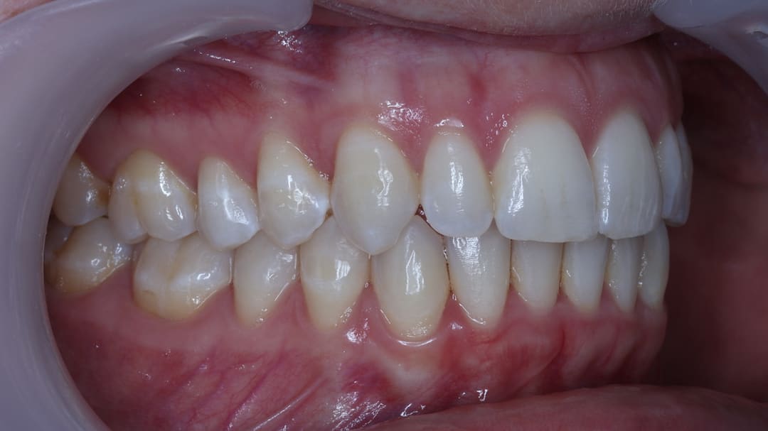 After — patient I, orthodontics