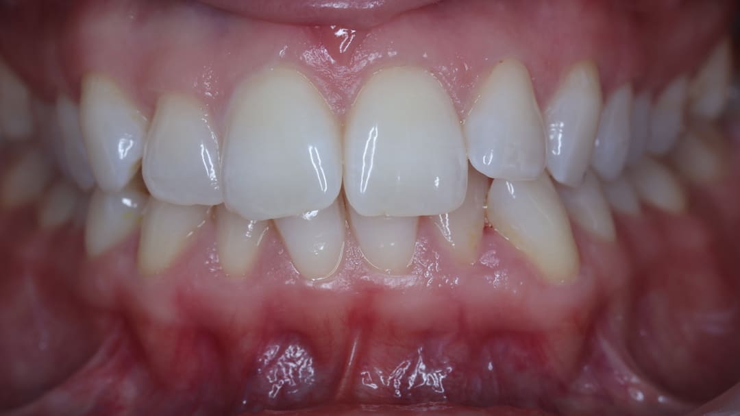 Before — patient TF, orthodontics